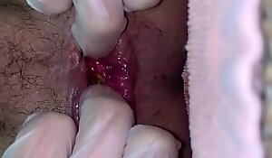 Self distension for anal butt-hole